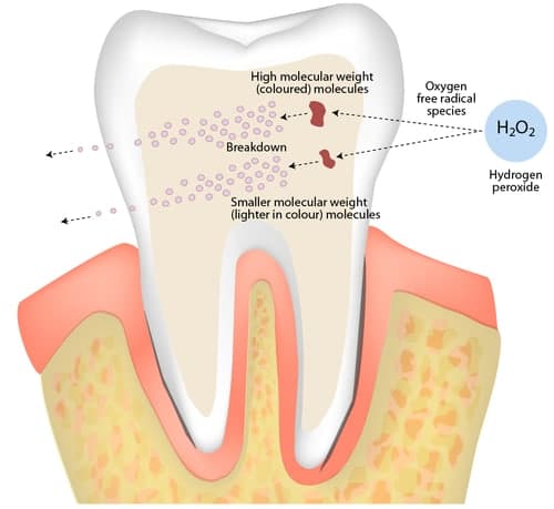 Expert Teeth Whitening Approaches Cost And Even More