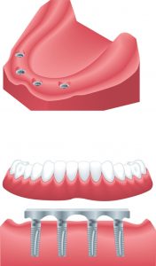 implant retained denture