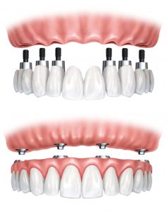 implant supported hybrid bridge