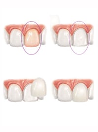 porcelain veneers illustration