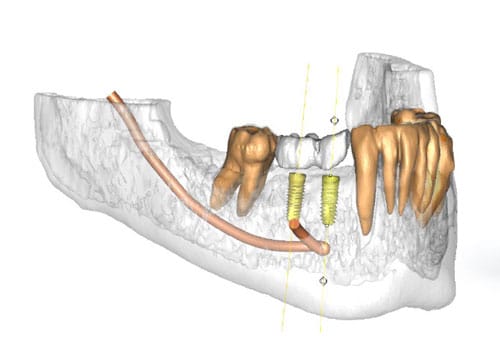 interactive 3D implant planning