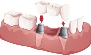 Implant supported bridge