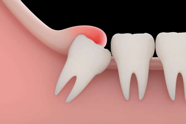 Wisdom Tooth