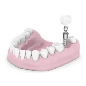 implant supported crown
