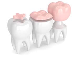 Tooth Fillings - Tooth Fillings - Inlays, Onlays, and Crowns