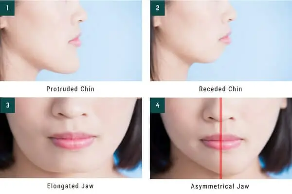 elongated receded chin jaw