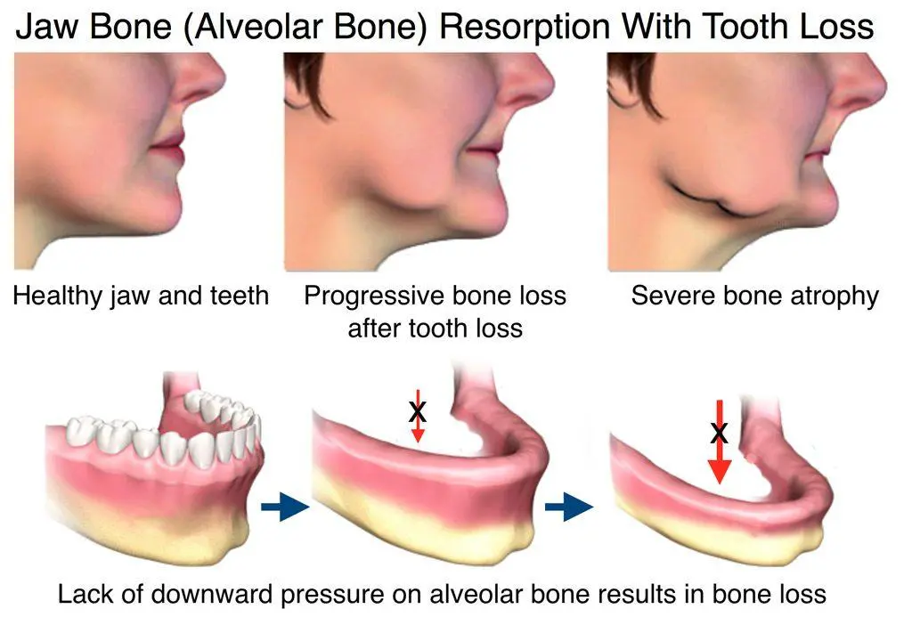 The Effects of Ill-Fitting Dentures