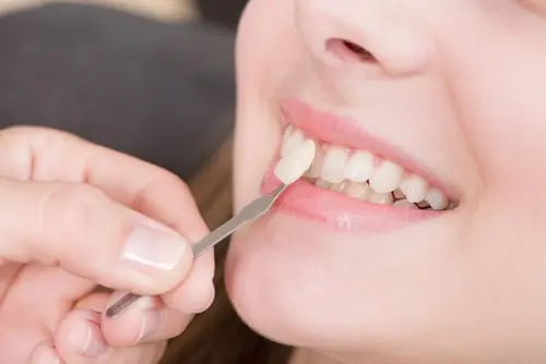 Placing Veneers for Straightening Teeth