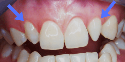 Oddly Shaped Front Teeth Which Can Be Easily Corrected