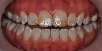 Severe Internal Staining of Teeth