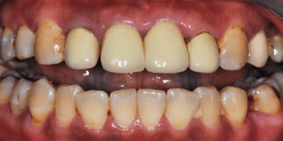 Stained Old Crowns on Teeth