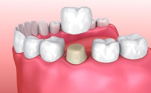 Placing Crowns for Straightening Teeth