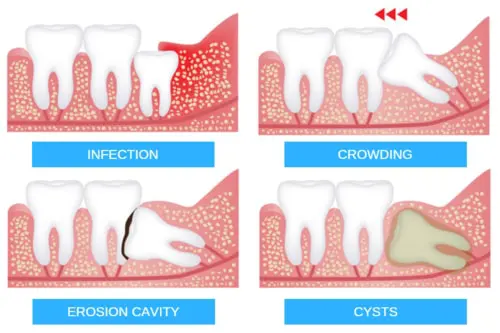 normal wisdom teeth growth