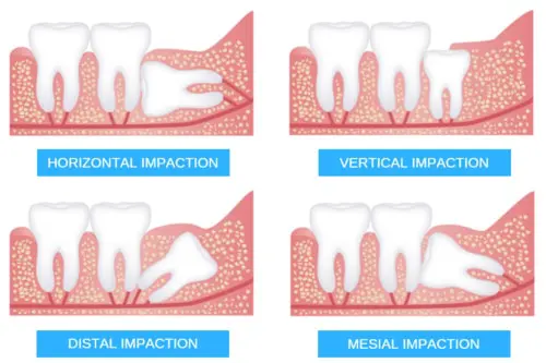 8 Things You Need To Know About Wisdom Teeth Tds Singapore