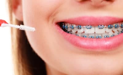 metal braces for teeth straightening