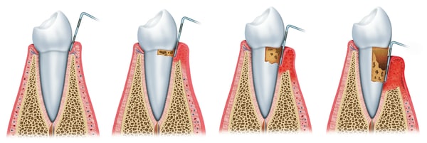 gum disease