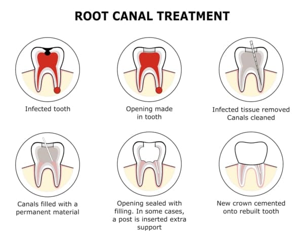 root canal treatments