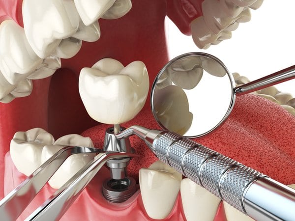 Time Needed for Dental Implants to Heal