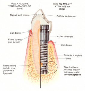 Origin of Dental Implants