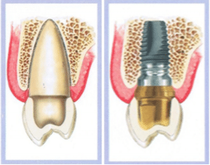 What is Dental Implant