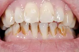 Extrinsic stained teeth