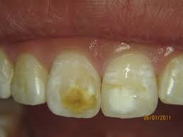 Excessive Flouride Stained Teeth