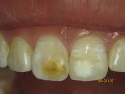 Excessive Flouride Stained Teeth