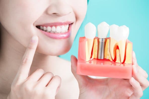 How Long Do Dental Implants Last
