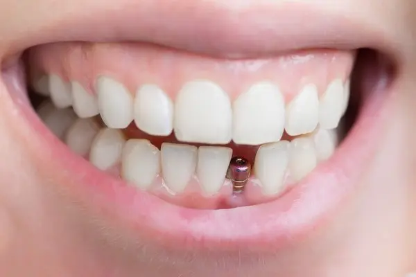 Screw on Teeth For Dental Implant