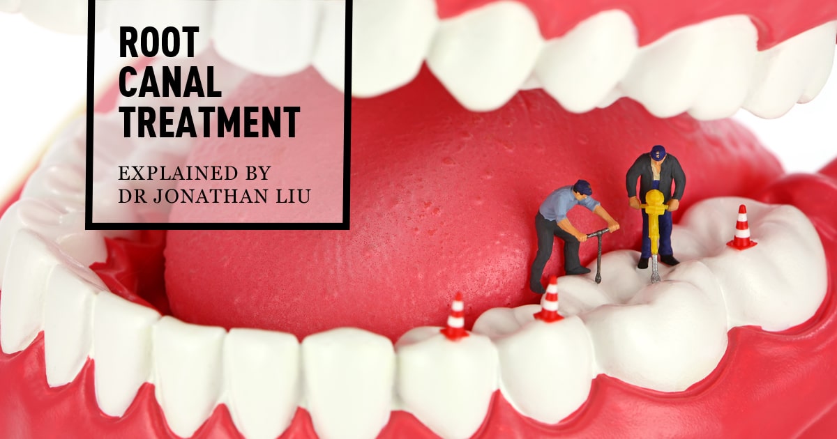 The Essential Goal of Root Canal Therapy Telegraph