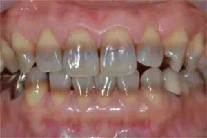 Stained teeth - Tetracycline