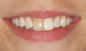 Traumatic Injury to Tooth Discolouration