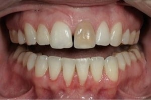 Tooth Discoloration from Root Canal Treatment