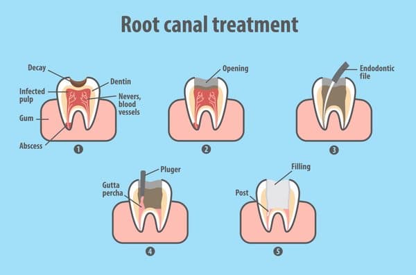 How Long Does It Take To Do A Root Canal Procedure : The study reported