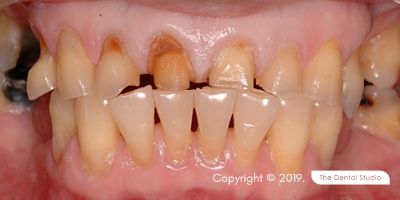 Biting Hard Food Front Teeth Example