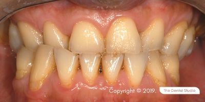 Loss Back Teeth Example