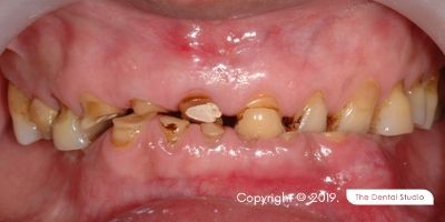 Teeth Grinding Example