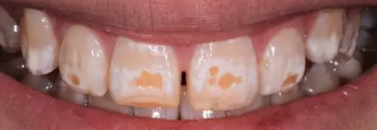 Severe teeth discolouration