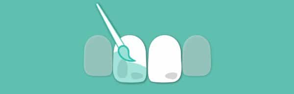 Apply a liquid resin - ICON on the tooth surface