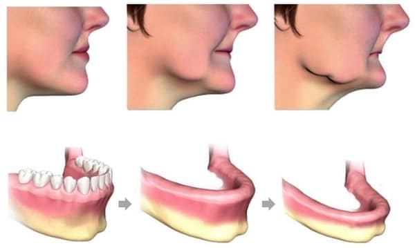 Old Age Bone Resorption