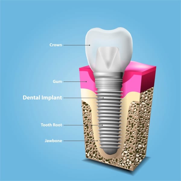 The Structure of Dental Implant