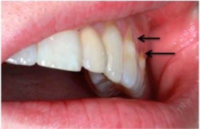 Sensitive Teeth Due to Dental Abrasions