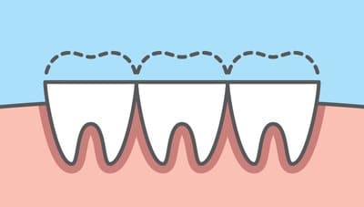 Causes of Sensitive Teeth and How to Treat Them