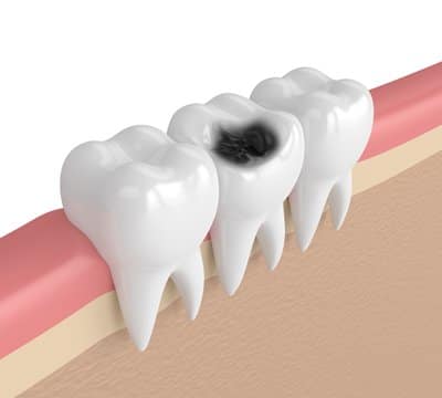 Tooth Sensitivity Due to Dental Decay