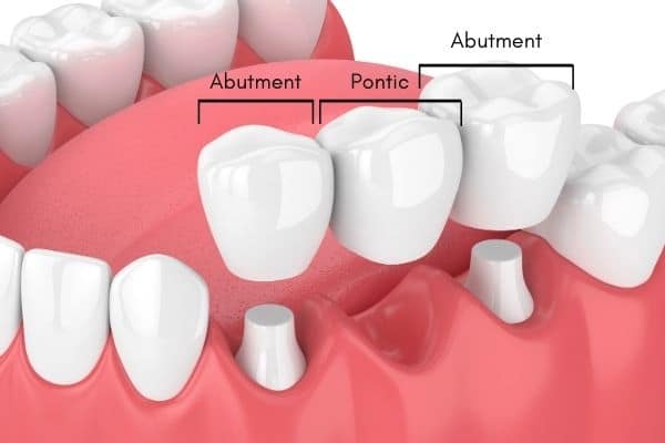 How to Take Care of Dental Bridges?