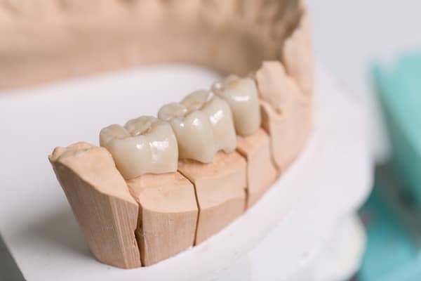 Dental Bridge Feels Natural and For Better Pronunciation