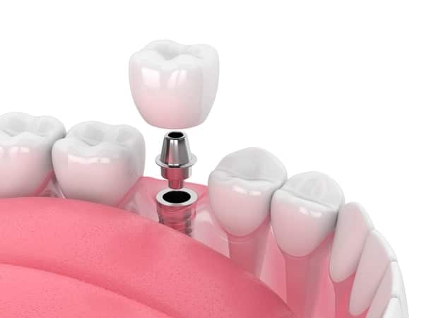 Dental Implants Procedures