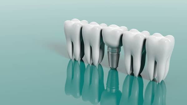 Dental Implant is a Titanium Screw That Sits in Your Bone