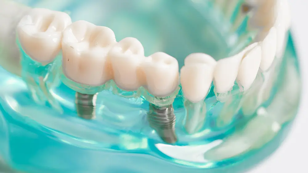 Dental Implants Replace Teeth