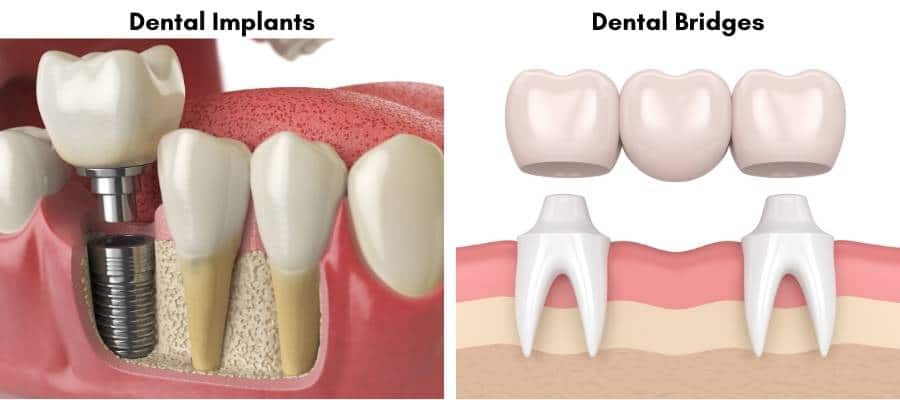 Dental Bridges and Dental Implants Comparison